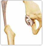 Lower Bone of Hip Before Implant - Dr Niraj Vora